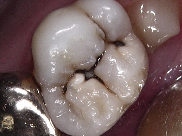 虫歯症例1治療前
