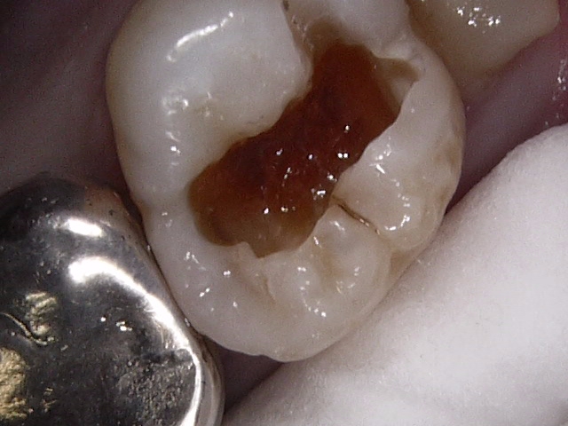虫歯症例1治療中