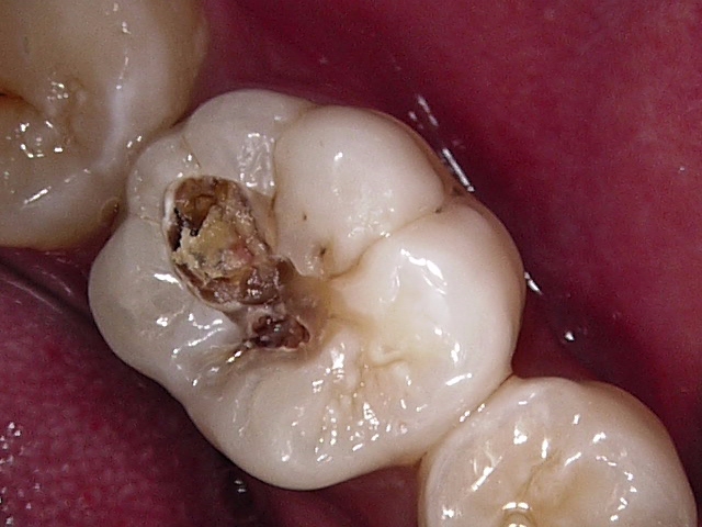 虫歯症例3治療中