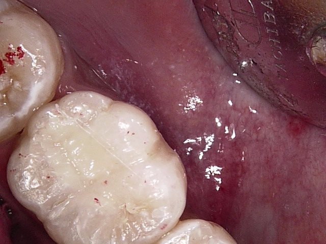 虫歯症例3治療後