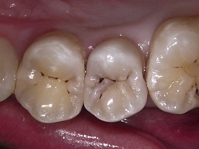 虫歯症例4治療前