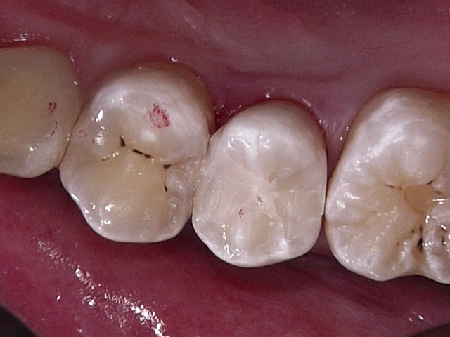 虫歯症例4治療後