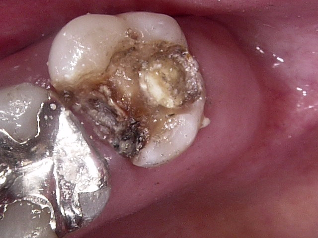 虫歯症例6治療中