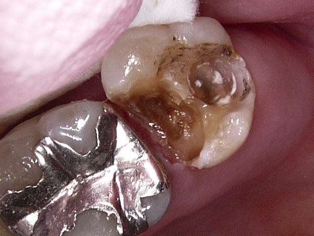 虫歯症例6治療後